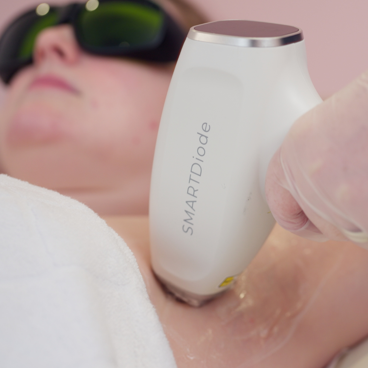 Micro Area Laser Hair Removal Glasgow, Bristol & Aberdeen PURE Spa