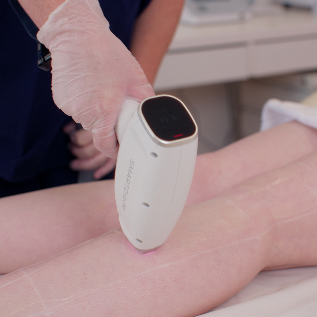 Laser Hair Removal treatment on a medium body area at PURE Spa UK