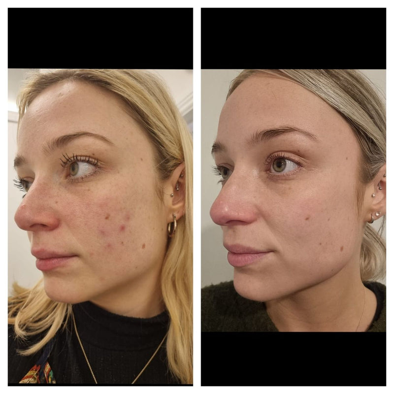 Face Cryo Sculpting - 20 min Treatment