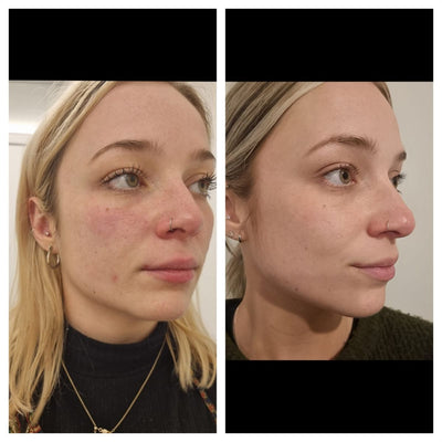 Face Cryo Sculpting - 20 min Treatment