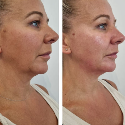 Face Cryo Sculpting - 20 min Treatment