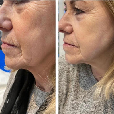 Face Cryo Sculpting - 20 min Treatment