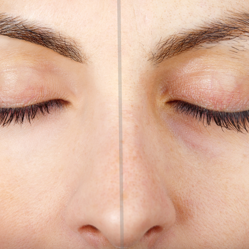 Centre Brow Laser Hair Removal
